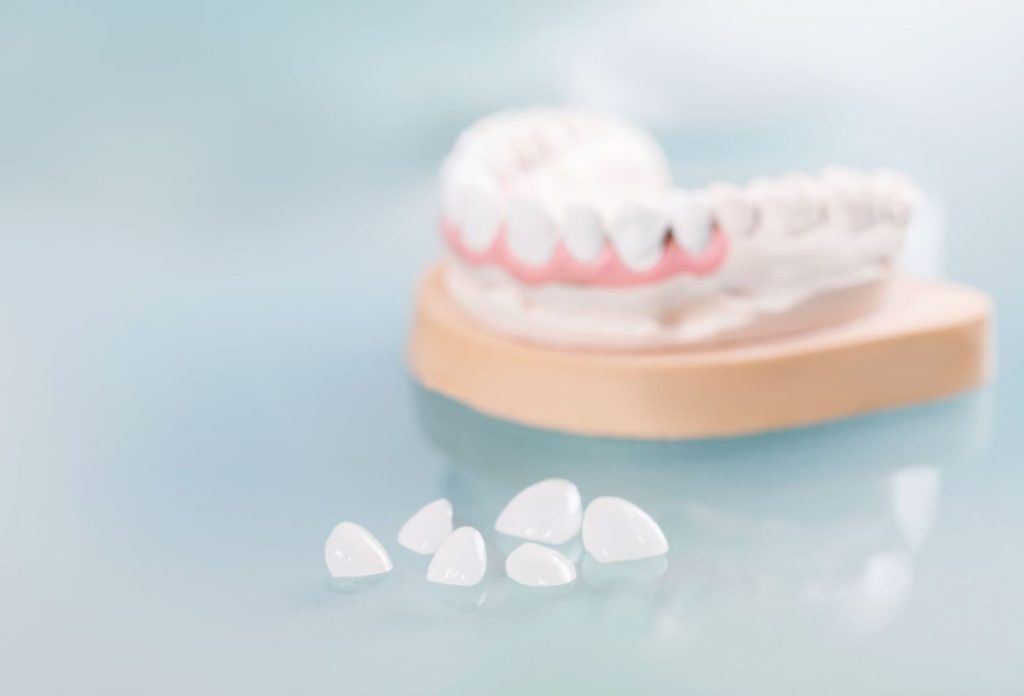Faccette Dentali 1 FACCETTE DENTALI a Montebelluna
