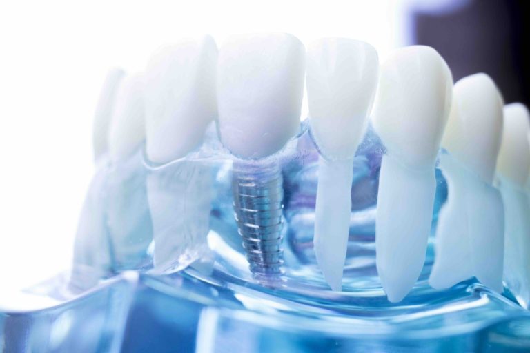 Impianto dentale e allergie - Glossario implantologia dentale a Montebelluna