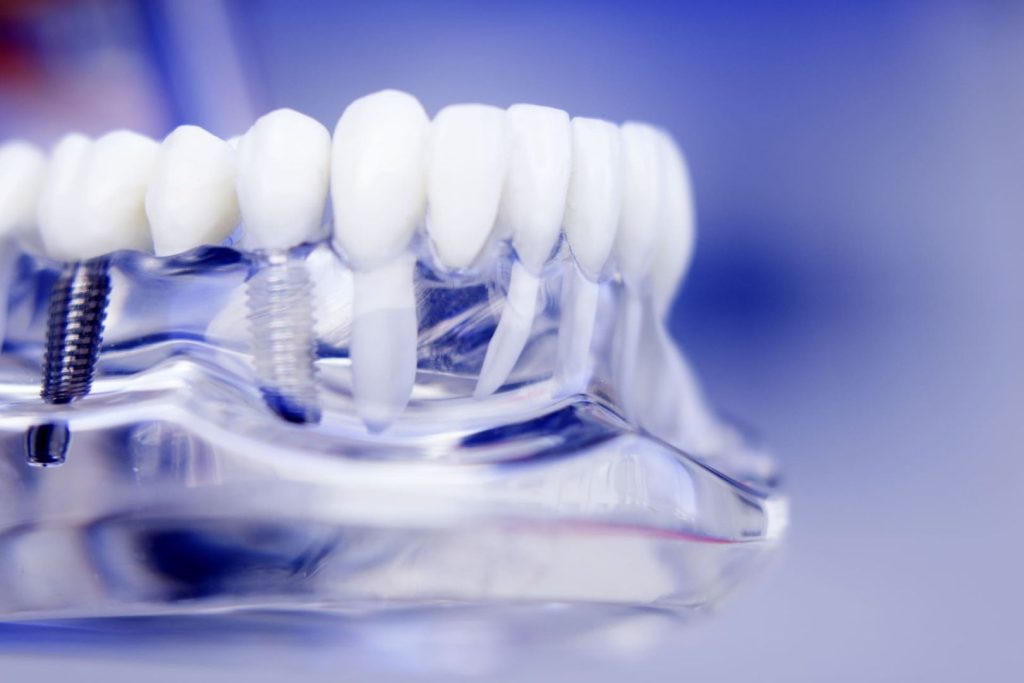 Glossario implantologia dentale a Montebelluna
