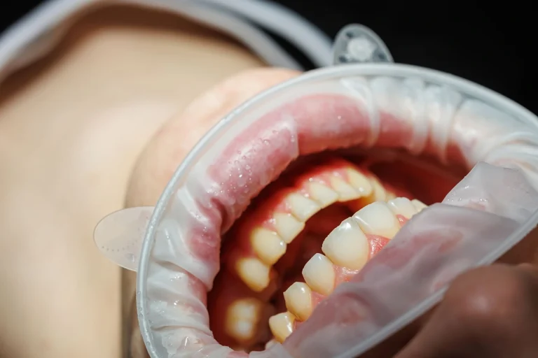Glossario igiene orale, prevenzione e parodontologia a Montebelluna - Igiene dentale