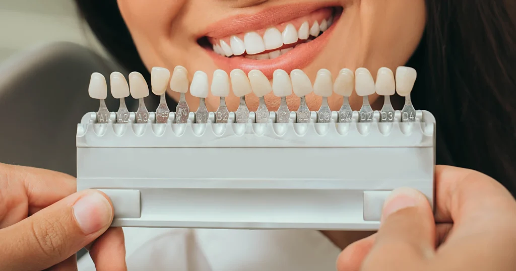 Glossario odontoiatria estetica a Montebelluna
